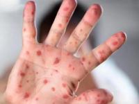 child's hand with measles. Photo iStock